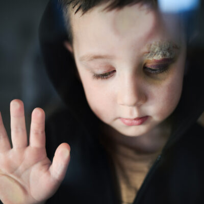 Et barn med et kutt over øyet.